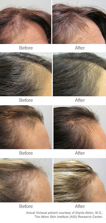 Viviscal before and after result pictures showing hair regrowth