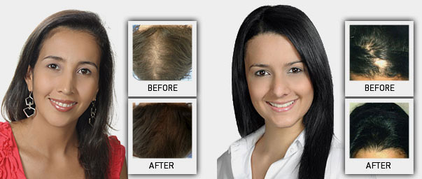 biologix hair restoration pictures