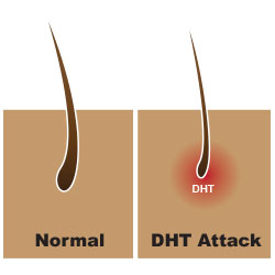dht hair loss for women