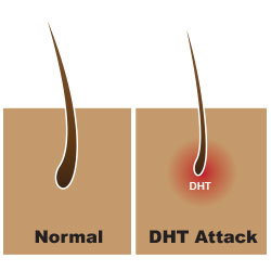 dht hair loss