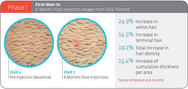 replicel clinical trial result