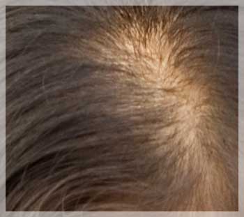 androgenetic alopecia in women image