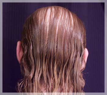 Women S Hair Loss 101 Types Of Hair Loss In Women