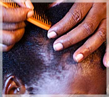 traction alopecia photo image