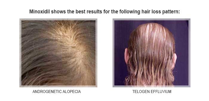 minoxidil and female hair loss pattern