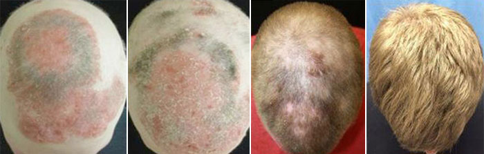 hair regrowth arthritis drug