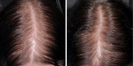 rogaine for women before and after pictures part