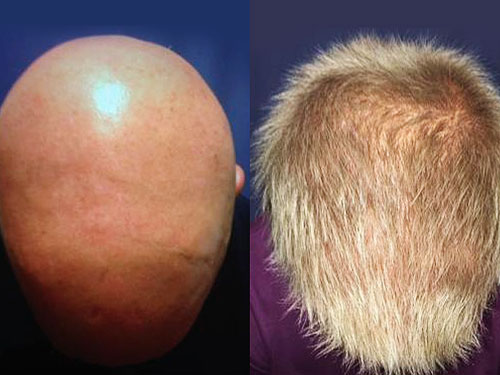 JAK Inhibitor alopecia hair loss cure