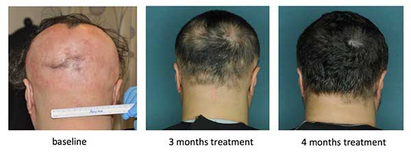 alopecia areata cure fda approved drug jak inhibitors