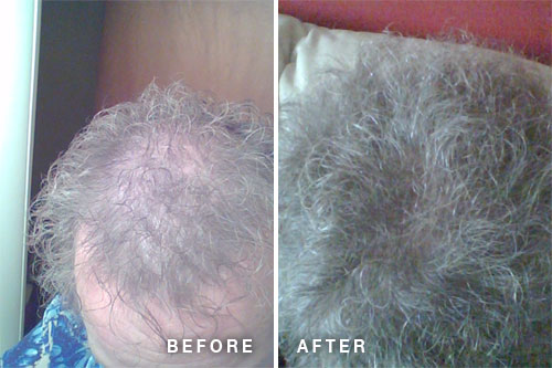 hair essentials hair loss improvement before and after photos