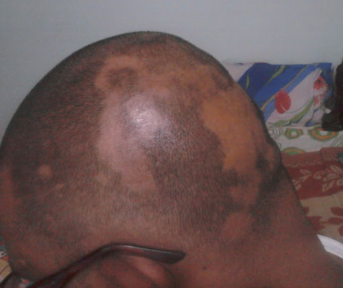 white iodine for hair loss alopecia areata regrowth