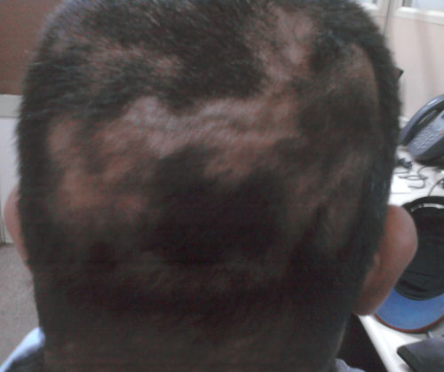 white iodine for hair loss alopecia areata regrowth