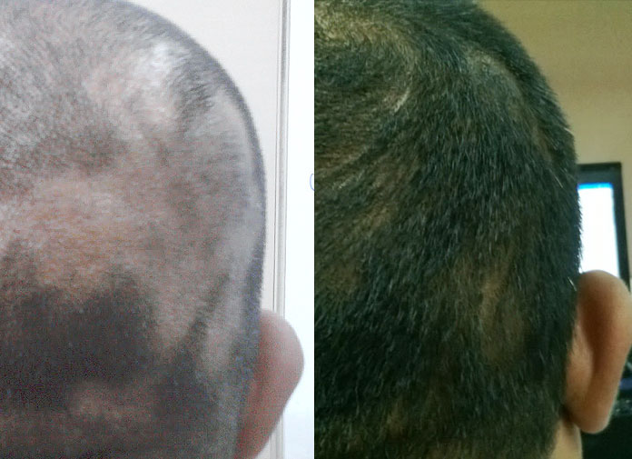 tincture of iodine for hair loss alopecia areata success stories