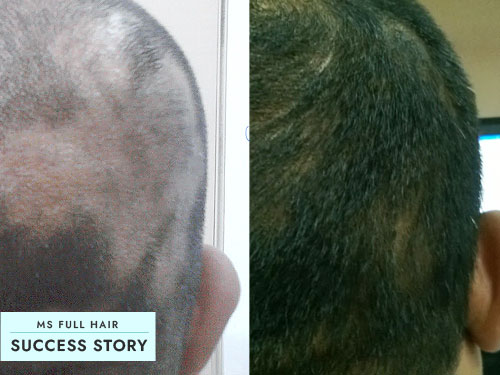 tincture of iodine for hair loss