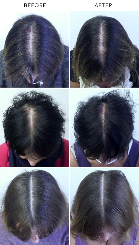 black currant oil hair loss growth before and after pictures