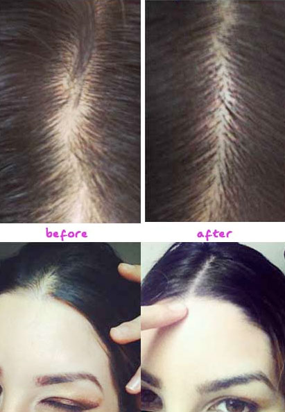 castor oil hairline before and after regrowth photos