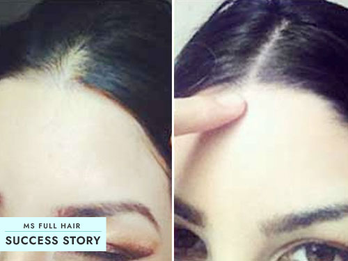 hair loss success story castor oil for hair regrowth