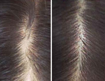 castor oil for hair before and after regrowth pictures