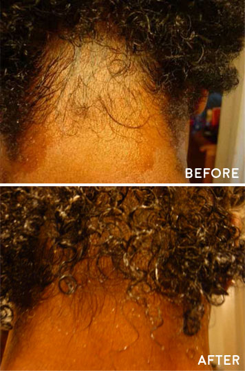castor oil for hair growth before and after results