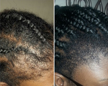Jamaican black castor oil for hair growth before and after pictures