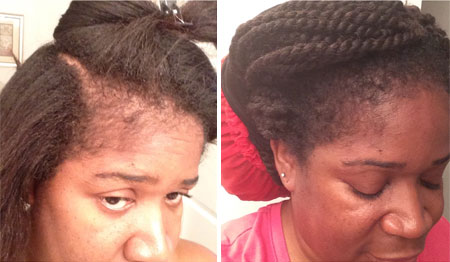 Jamaican black castor oil for hair loss before and after pictures