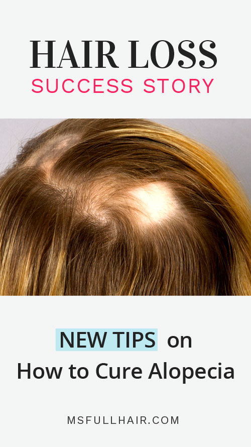 hair loss success story for alopecia areata cure and remedies