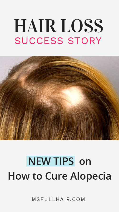 Alopecia Areata Success Story Healing It Naturally With This Method 