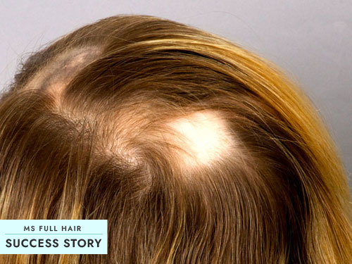 healing alopecia areata naturally hair loss success story