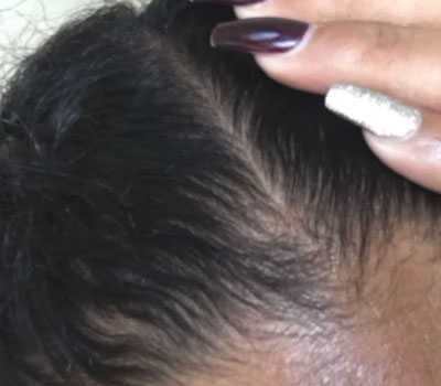bald stop treatment for black hair