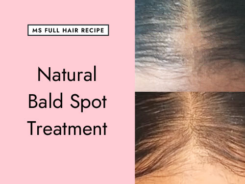 Bald Spot Growth Recipe (According to Hair Loss Success Story) bald spot treatment hair loss success story