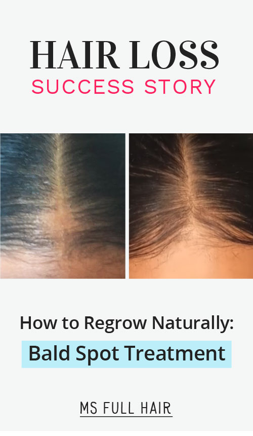 best bald spot treatment female natural hair loss remedy
