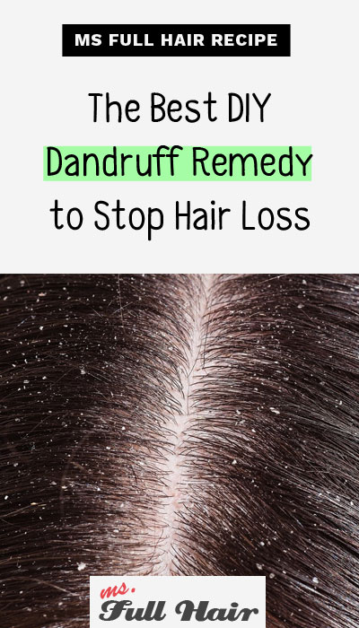 best diy severe dandruff remedy to stop hair loss