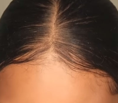 hair loss success story bald spot cure before and after photos