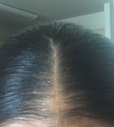 Hair loss success story best bald spot treatment natural remedy before photo