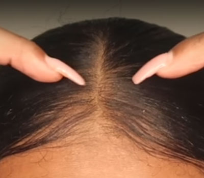how to make bald spots grow natural remedy