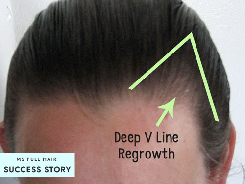 Scalp Brushing to Regrow Hair - It Worked for Her Receding Hairline! Success Story