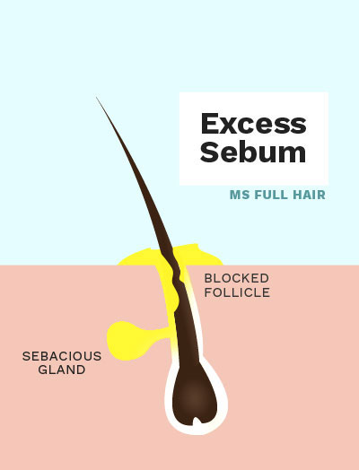 cedarwood essential oil for excess sebum hair loss