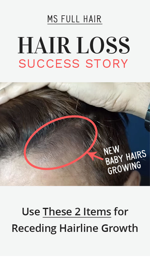 female receding hairline temples natural treatment