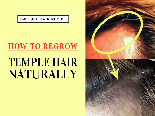 How to Regrow Temple Hair Naturally – Tips on Receding Hairline Treatment how to regrow temple hair loss naturally
