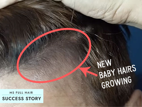 male female receding hairline natural treatment for hair regrowth