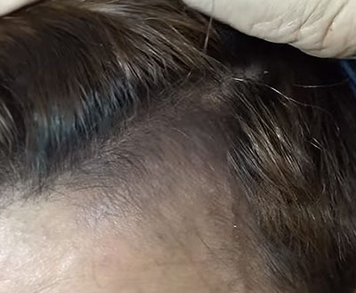 natural thinning hairline treatment after
