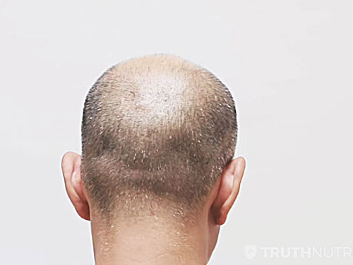 dht hair loss myth debunked