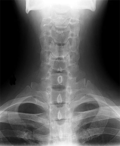 the most common causes of hair loss spinal vertebral subluxation misalignment