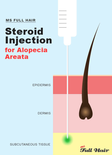 Steroid kenalog injection intralesional corticosteroids for alopecia areata