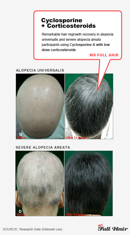 AA cyclosporine for alopecia areata treatment with corticosteroids