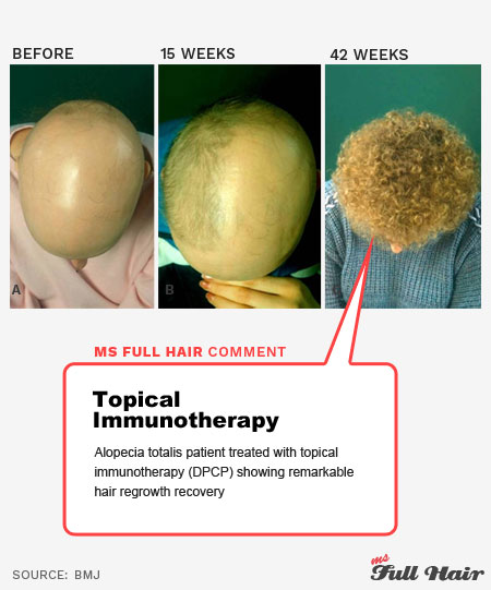 topical immunotherapy for alopecia areata