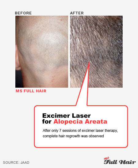 aa excimer laser light therapy for alopecia areata treatment