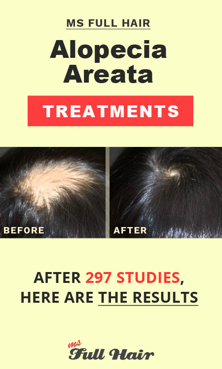 alopecia areata treatments that work
