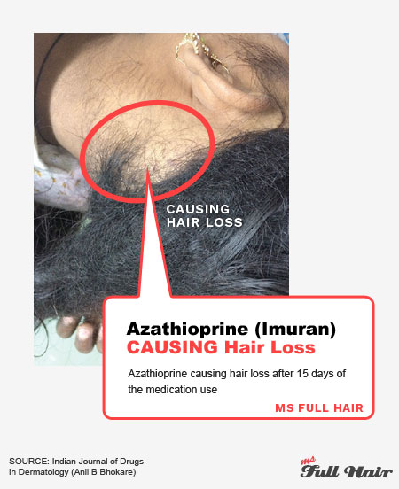 azathioprine imuran hair loss alopecia areata