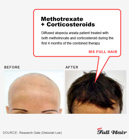 corticosteroids and methotrexate for alopecia areata 